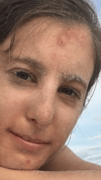 cicatrice d'acné avant