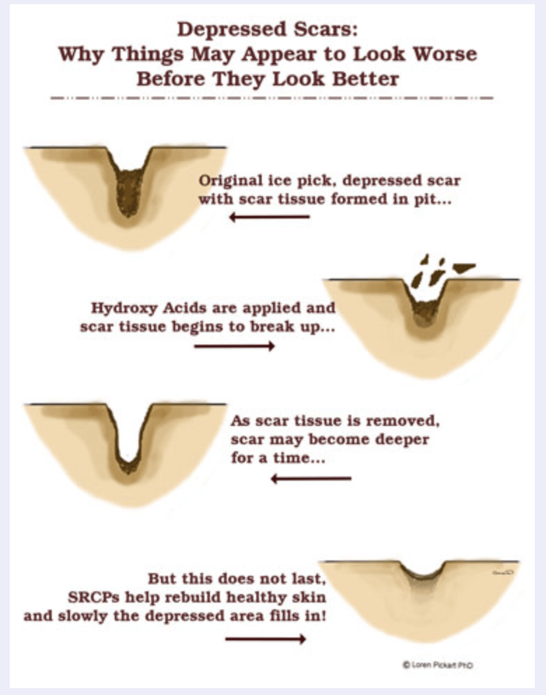 acne scar healing