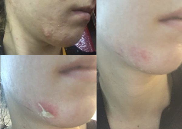 acne scar peel to heal