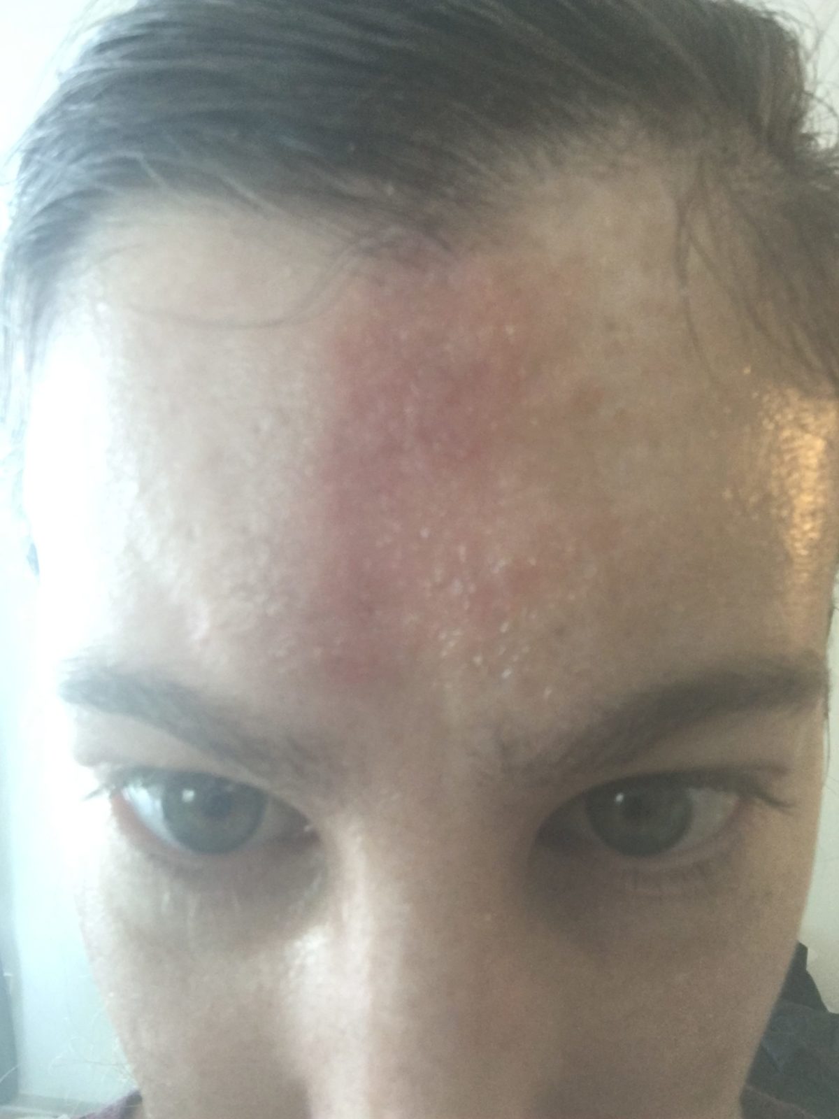 healing forehead