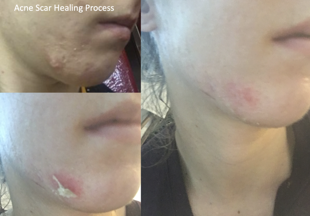 Acne Scar Healing Process