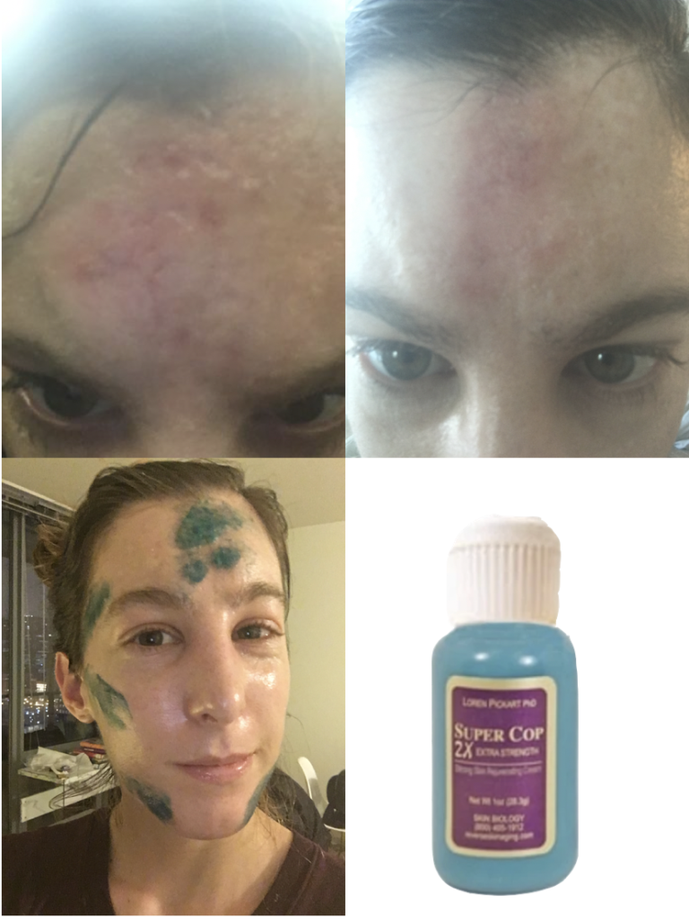 Acne Scar Treatment Kit The “Indented Scar Helper” Acne Scar Kit