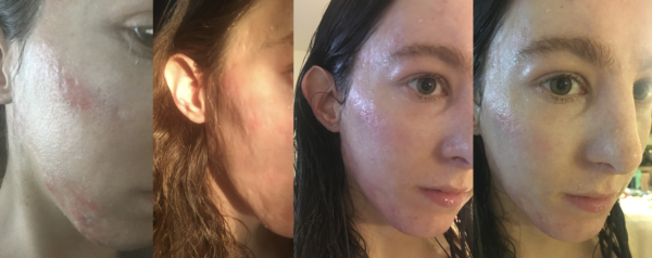 vitamin c and acne scar healing