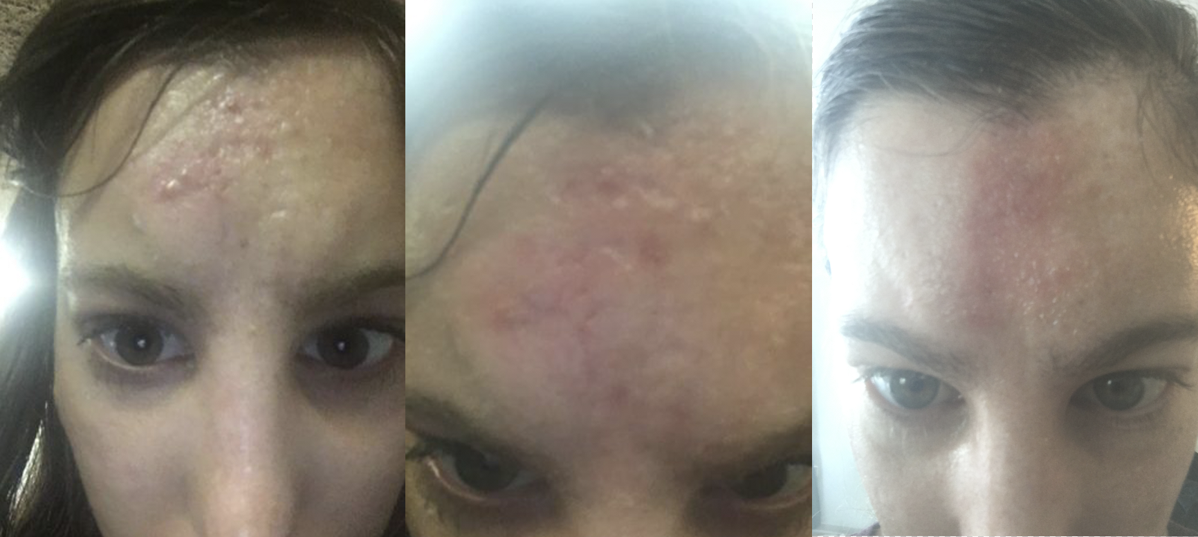 bad acne scars